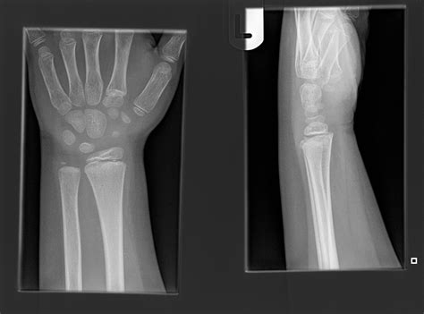 right radius fracture icd 10